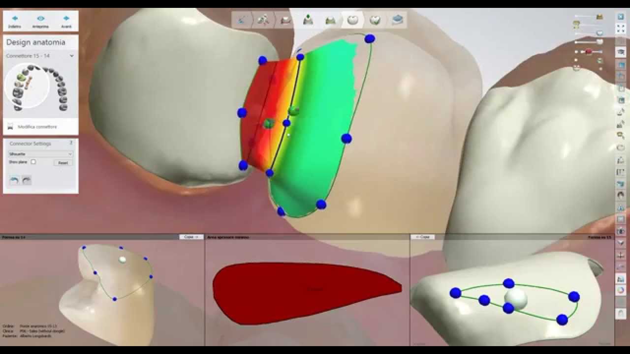 3Shape DentalSystem: Bridge Maryland like