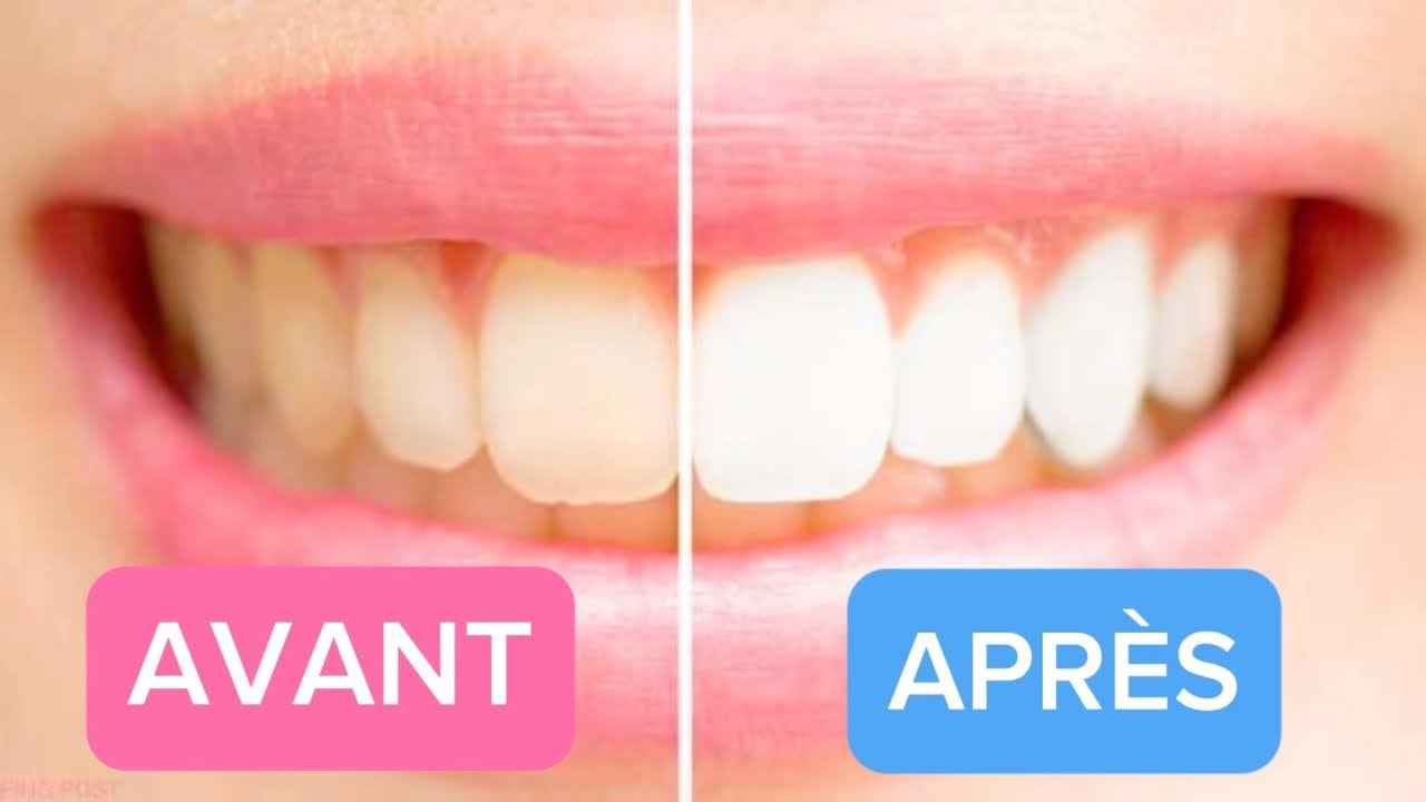 5 Astuces pour Avoir Les DENT BLANCHES &agrave; La Maison En 2 Minutes