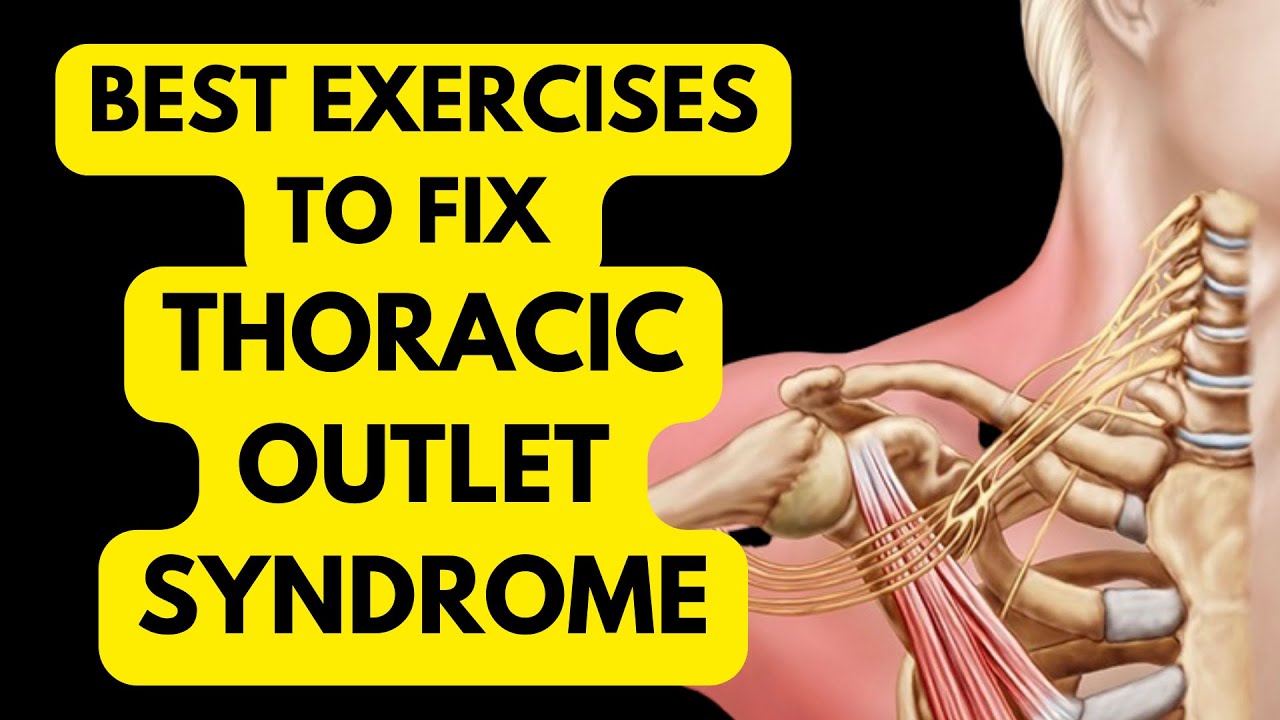 The Game-Changing Approach To Thoracic Outlet Syndrome (you’ve never tried this)