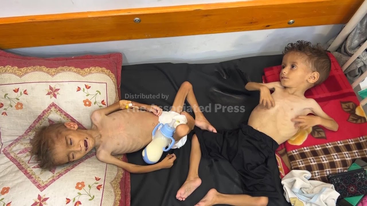 Starvation attacks the bodies of these children in Gaza