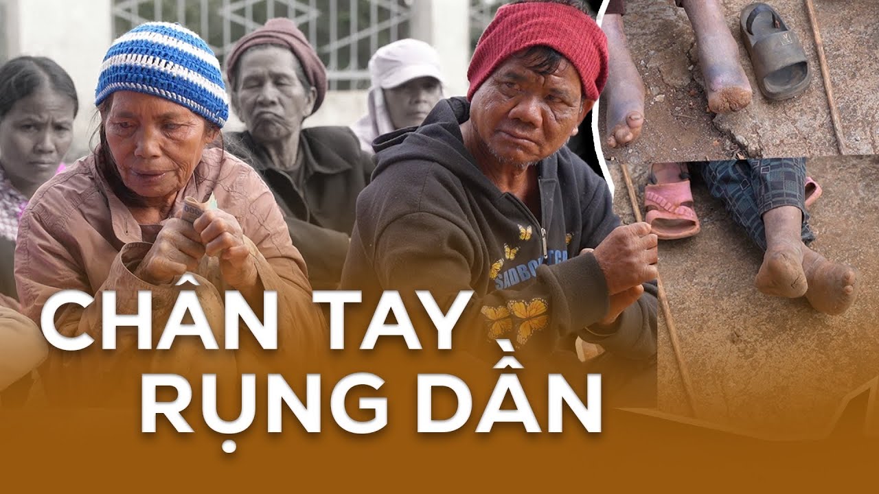 Ngôi Làng Nhiều Người Mắc Căn Bệnh Rụng Dần Cơ Thể