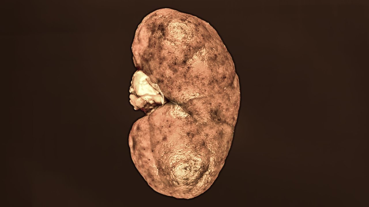A Dad Didn't Brush His Teeth For 40 Days. This Is What Happened To His Kidneys.