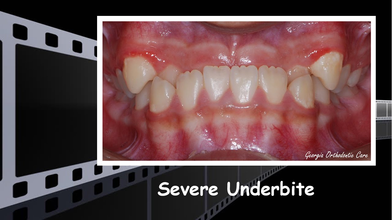 Severe Underbite Treatment