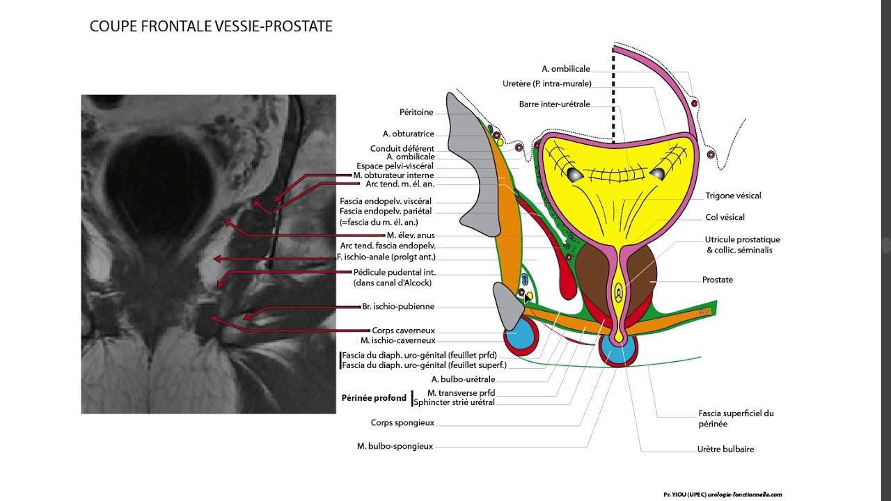 23 PROSTATE COUPE FRONTALE IRM