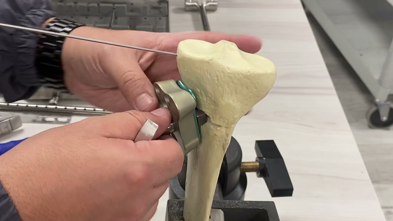 Placa OWO (Técnica Quirúrgica) osteotomia varizante