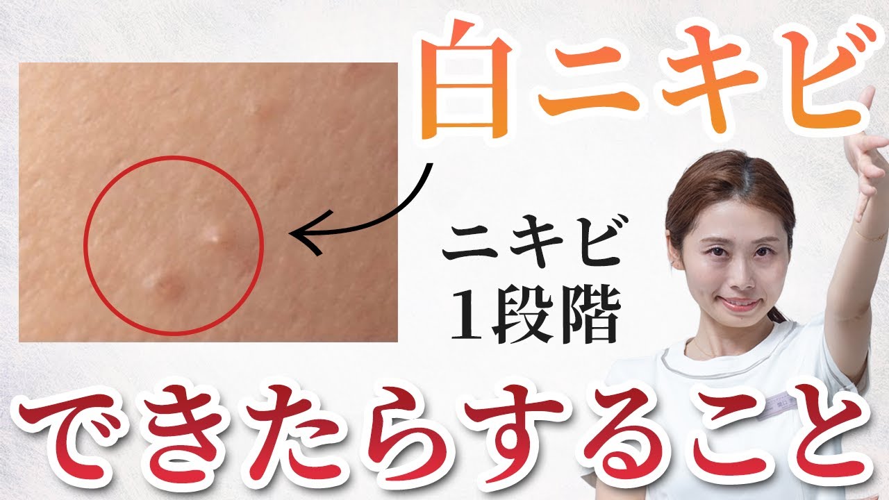【ニキビタイプ別①】白ニキビができたらすること！美肌のプロによるニキビ改善！