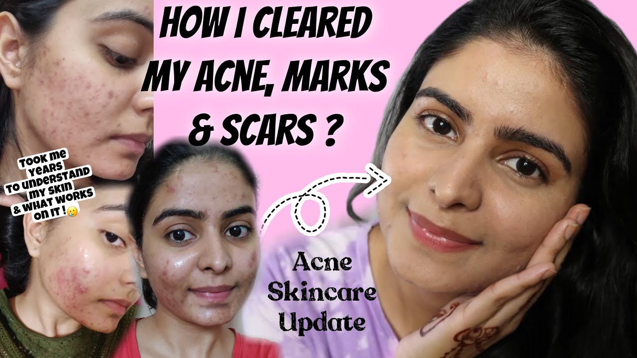 How to Fade Acne Marks & Scars | Hormonal Acne Skincare Routine #NotSponsored | Kashika