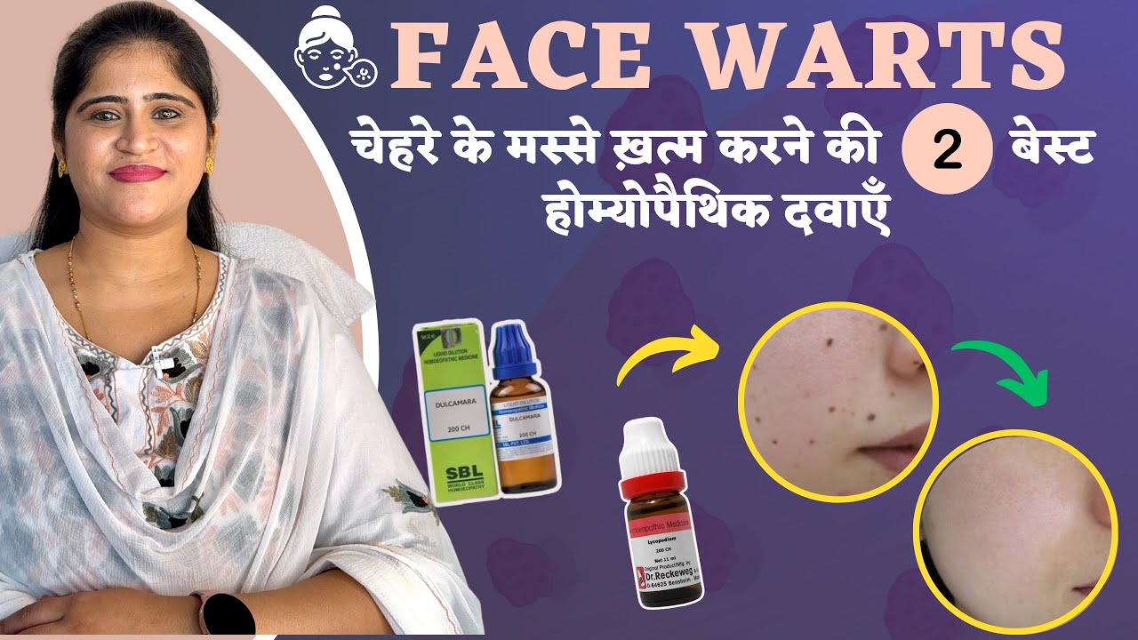 Facial Warts : चेहरे के मस्से ख़त्म करने की 2 बेस्ट होम्योपैथिक दवा | Warts Homeopathic Treatment |