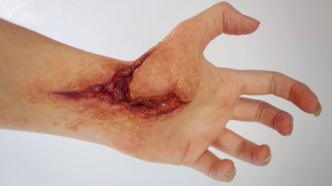 How to apply an encapsulated silicone prosthetic!