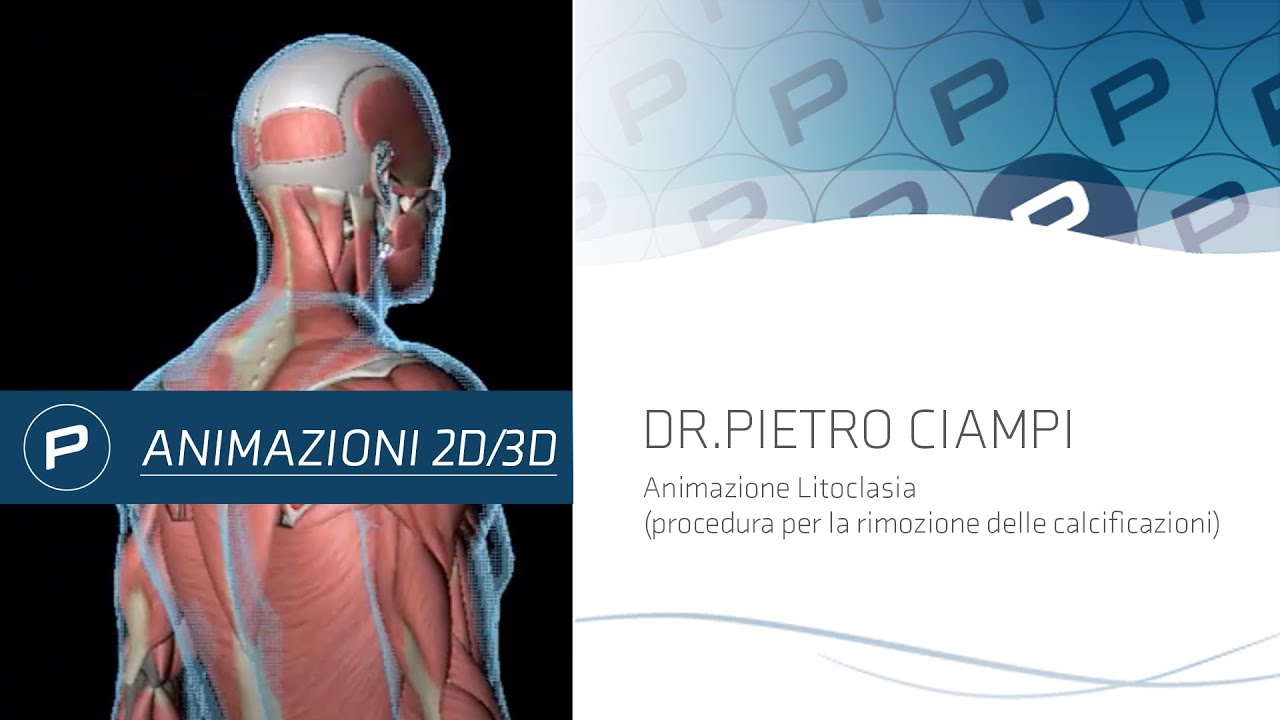 Dr. Pietro Ciampi - Animazione Litoclasia (procedura per la rimozione delle calcificazioni)