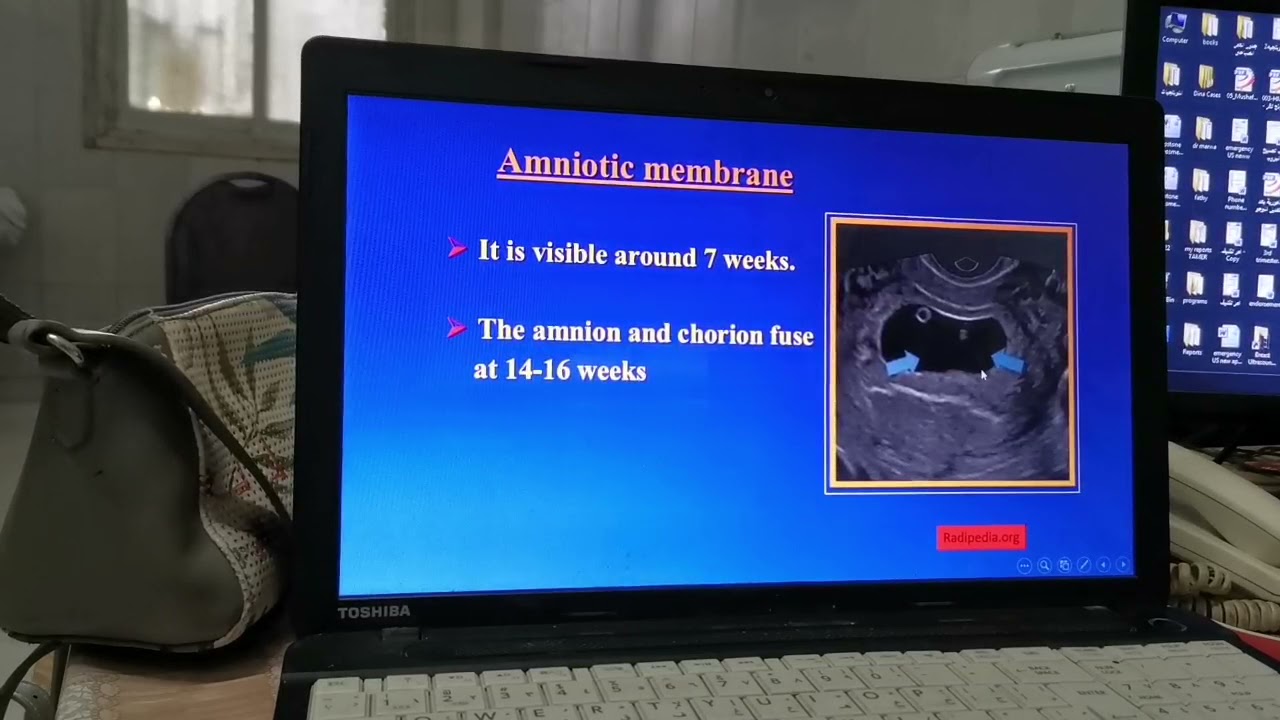 role of u/s in diagnosis of first trimester disordersدور السونار في تشخيص  الفترة الاولى من الحمل