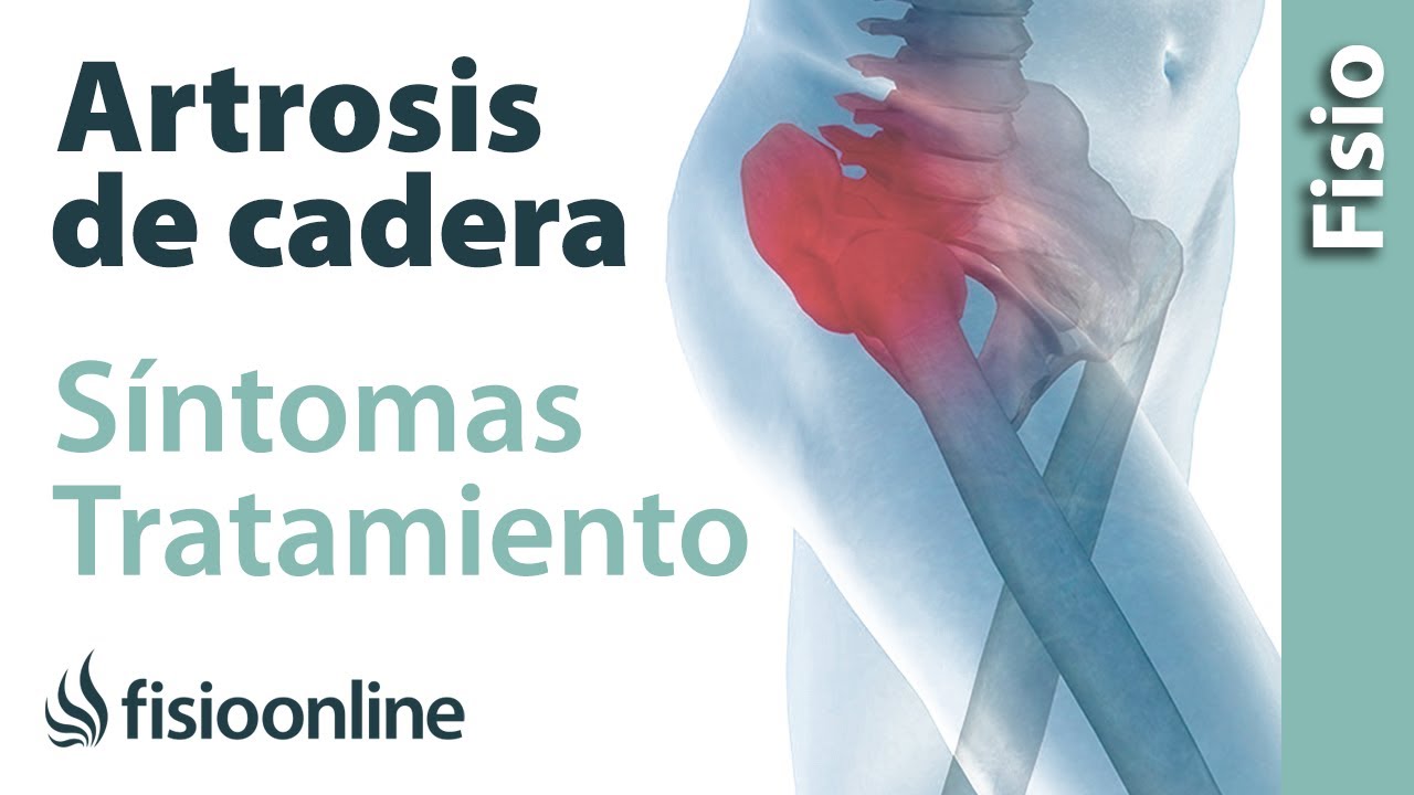 Artrosis o desgaste de cadera - Qu&eacute; es, causas, s&iacute;ntomas y tratamiento