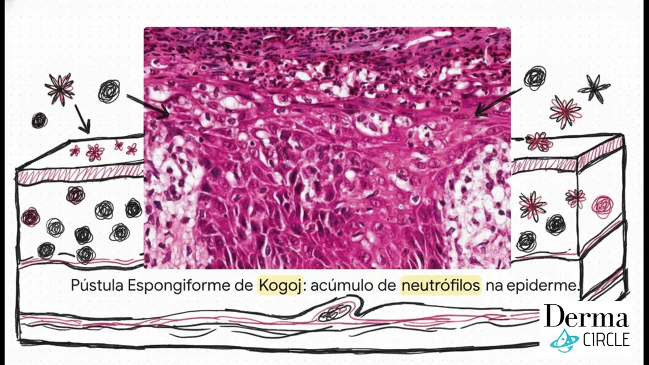 Resumo PSORIASE