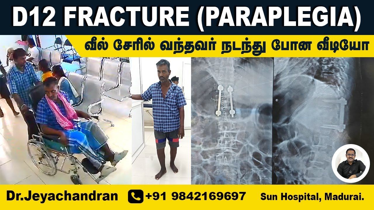 D12 SPINE FRACTURE PARAPLEGIA | வீல் சேரில் வந்தவர் நடந்து போன வீடியோ | Sun Hospital Madurai.