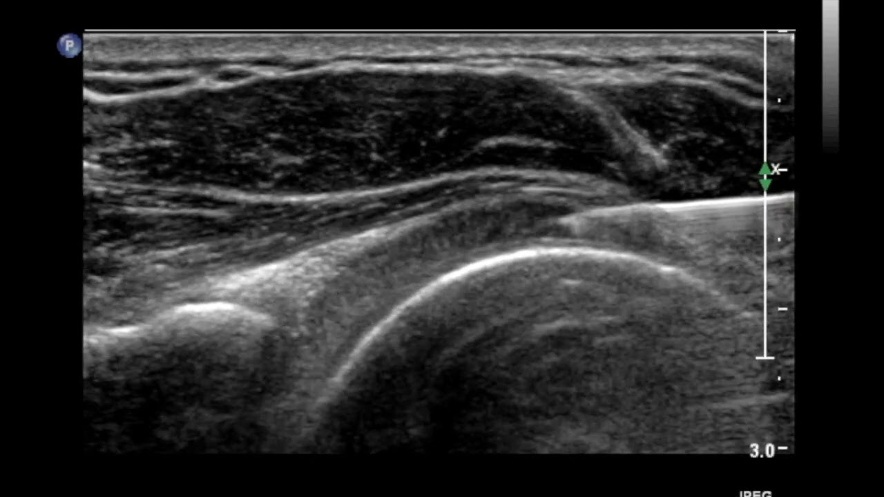 How to inject the Glenohumeral Joint (Shoulder Joint) under Ultrasound Guidance