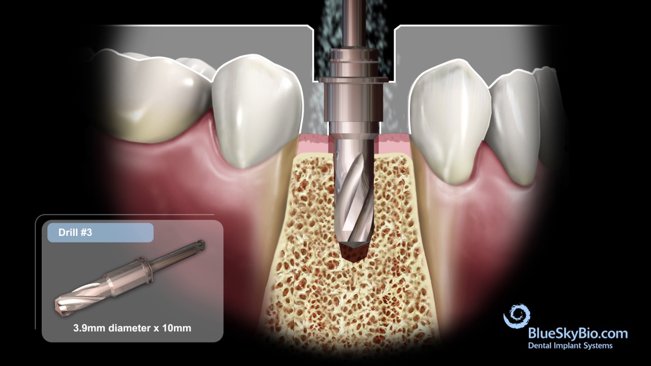 BIO | Max Fully Guided Surgical Kit (5.0mm Implant)