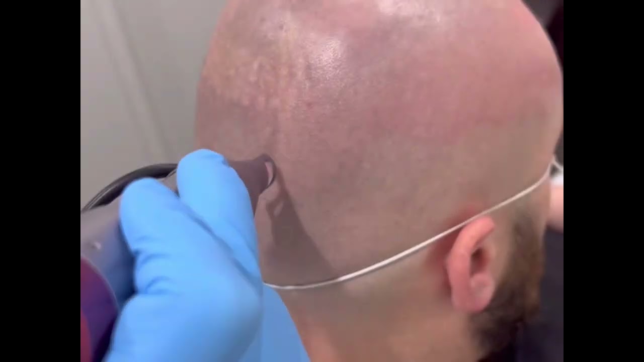 SMP (Scalp MicroPigmentation) Removal - First Treatment