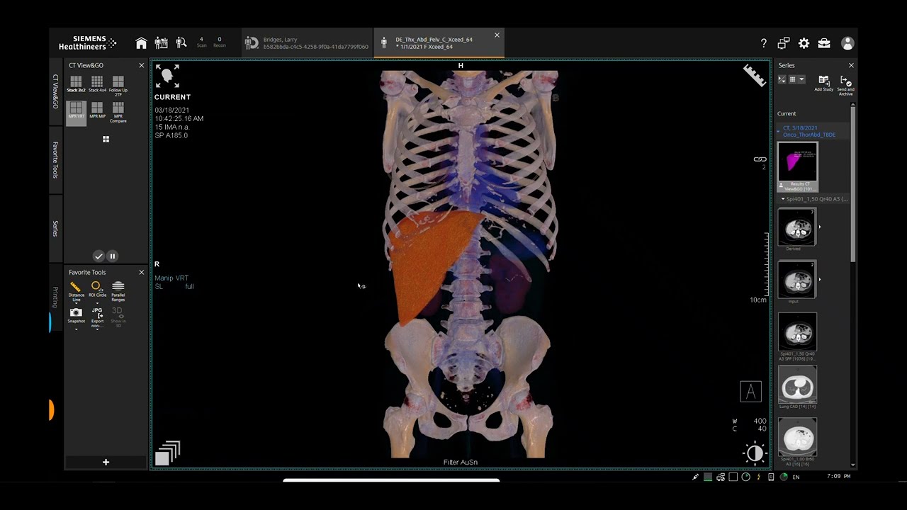 Region Growing - Anatomy Visualizer using Syngo.via and go/X Platforms