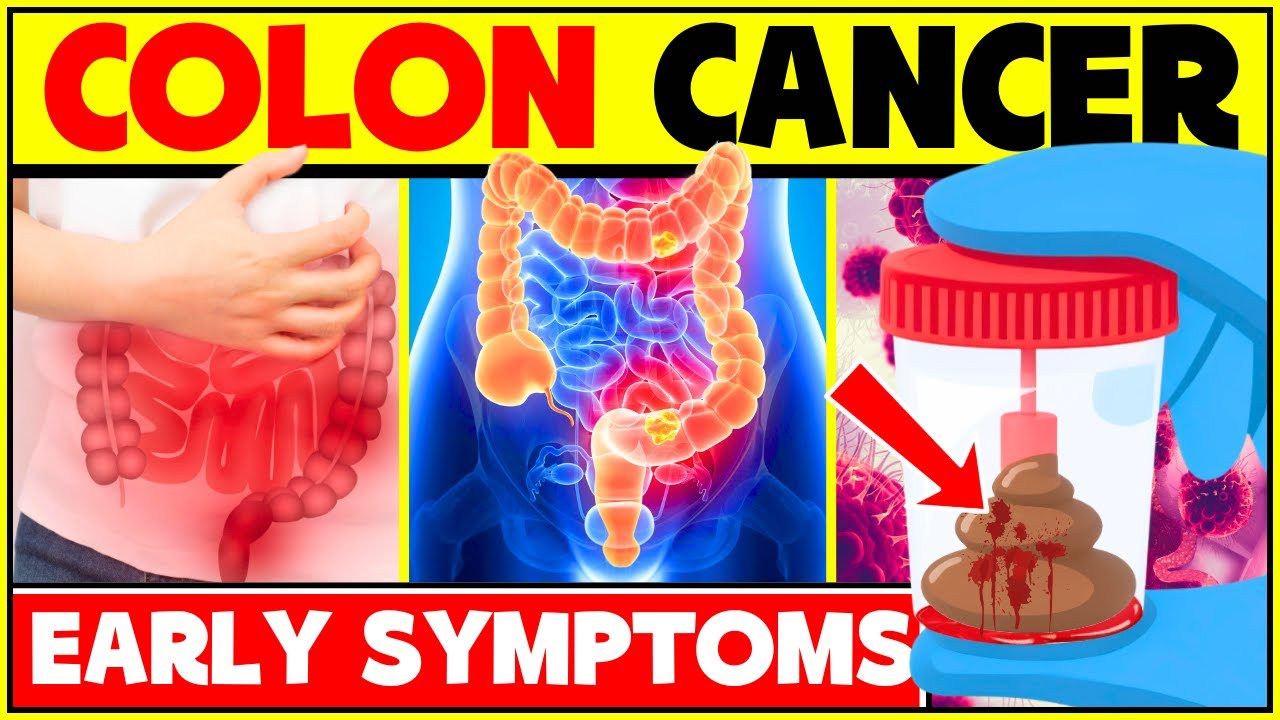 3 Early Signs And Symptoms Of Colon Cancer |  Warnings Signs Of Colorectal Cancer - Bowel Cancer
