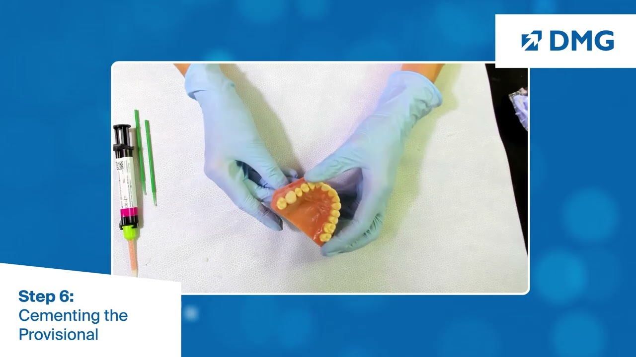 Clinical Provisional Crown and Bridge Workflow: Step 6, Cementing the Provisional