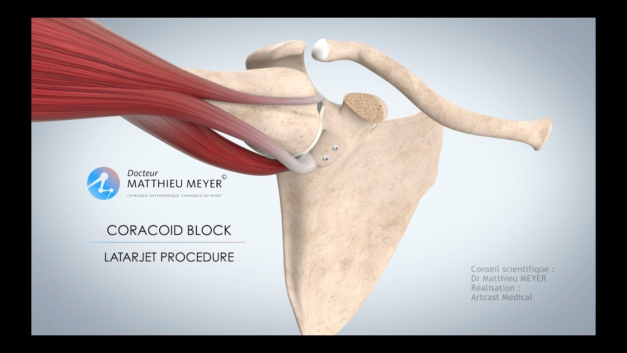 SHOULDER STABLISATION  BY CORACOID BLOCK  (LATARJET PROCEDURE) - DR MATTHIEU MEYER  - PARIS, FRANCE