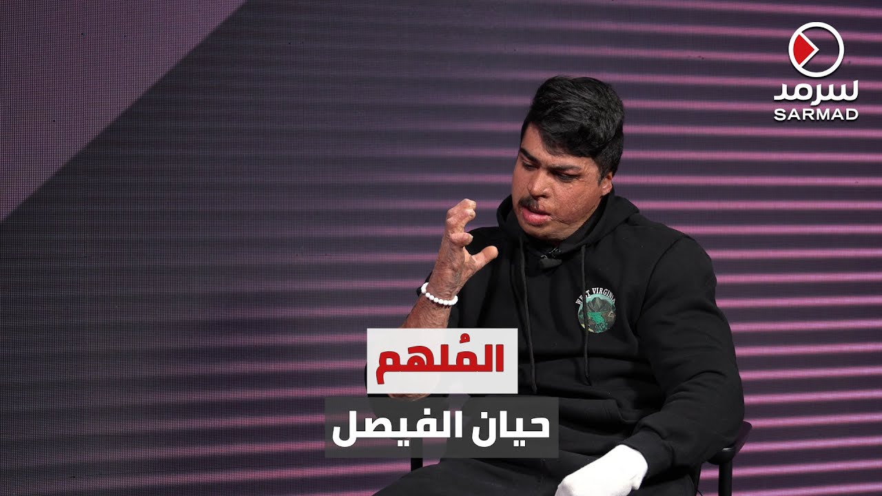 المُلهم حيان الفيصل.. كويتي يتحدّى اليأس .. الفيصل: تعرّضتُ لحرق متعمد وعمري 15 سنة.. بسبب خلاف