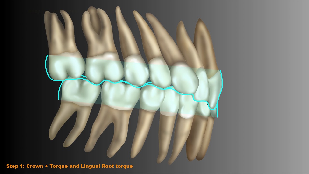 Invisalign: Deep Bite Protocols to succeed