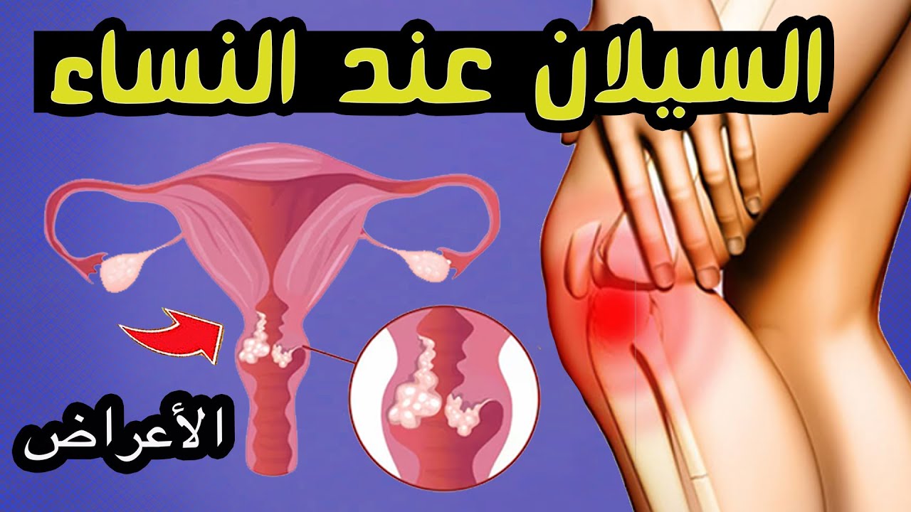 أعراض مرض السيلان عند النساء