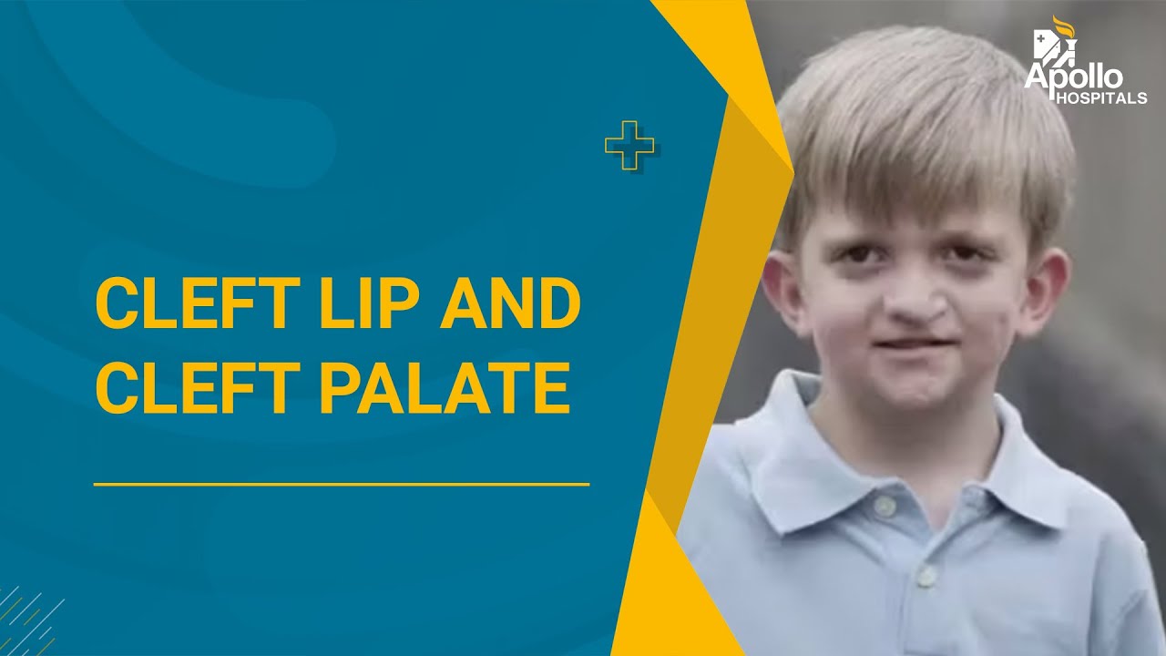 Cleft Lip and Cleft Palate - Common FAQs Answered | Diganosis, Risk Factors & Treatments Available