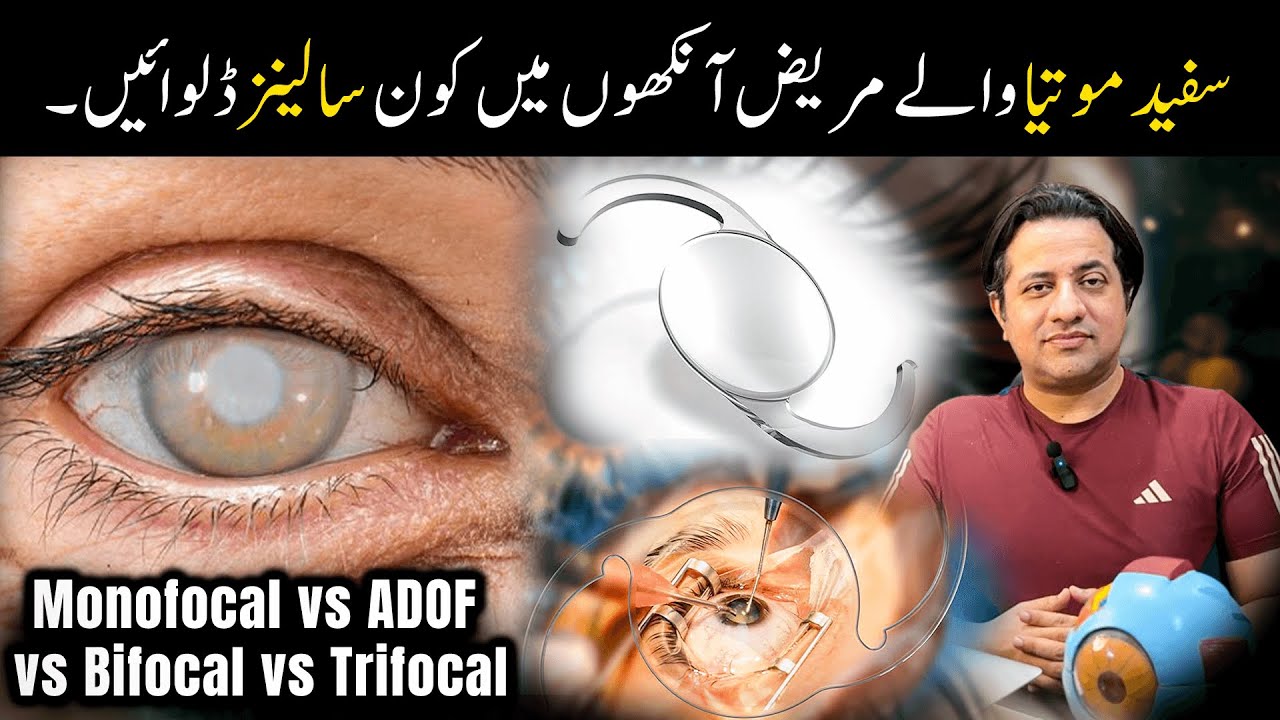 Which Cataract Lens is Best? Monofocal, ADOF, Bifocal, or Trifocal – Full Guide in Urdu/Hindi