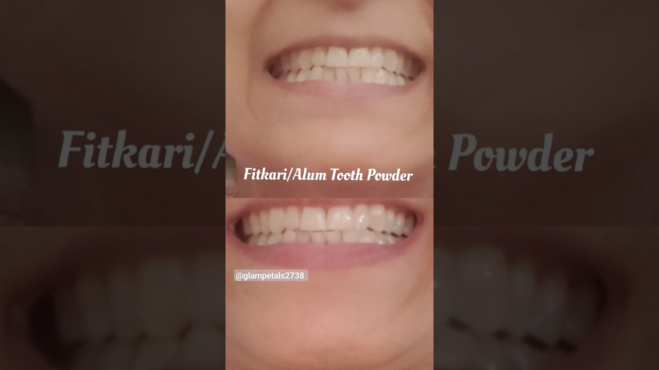फिटकरी दंत मंजन /Alum Tooth Powder#fitkari #alum #fitkaribenefits #fitkarifororalhealth
