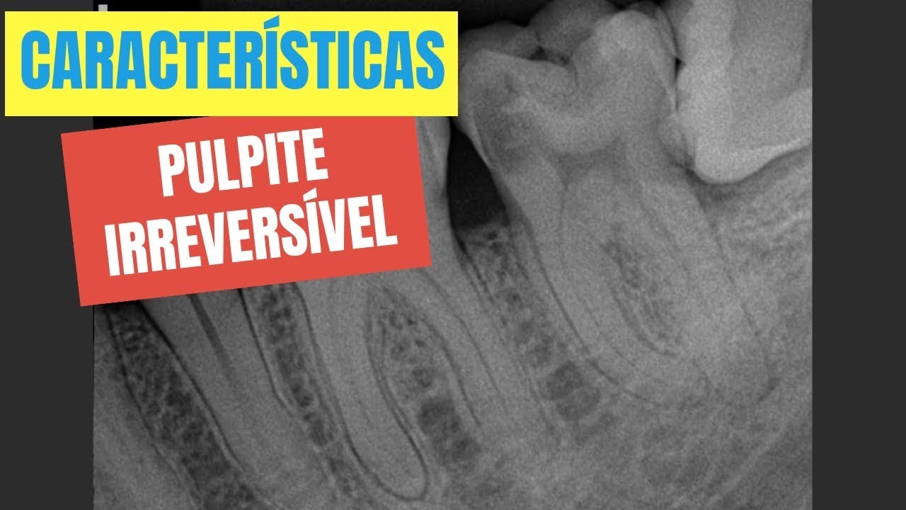 QUAIS S&Atilde;O AS CARACTER&Iacute;STICAS DE UMA PULPITE IRREVERS&Iacute;VEL? - QUICK TIP ENDOLOVERS