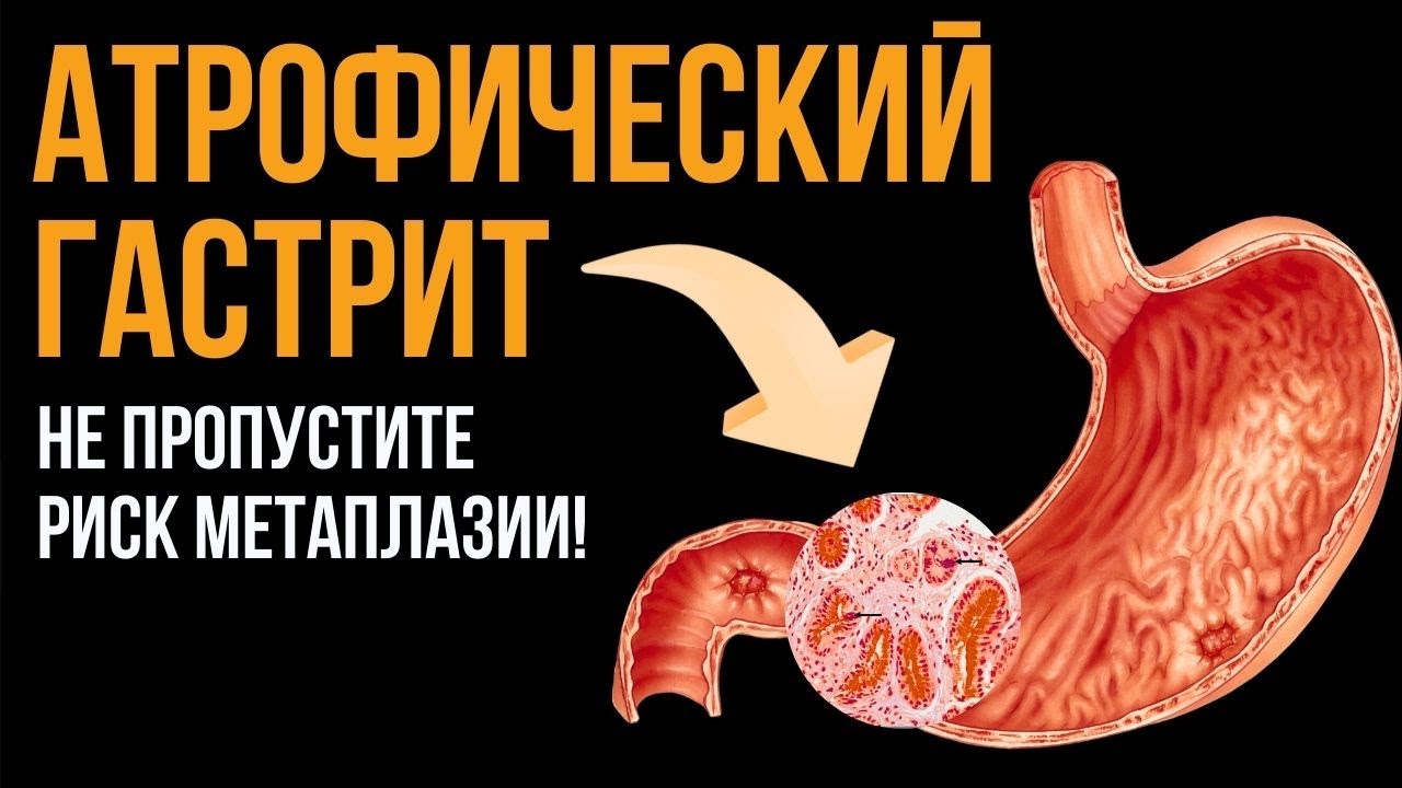 Атрофический гастрит с метаплазией в желудке: когда есть риск и как защитить слизистую желудка?