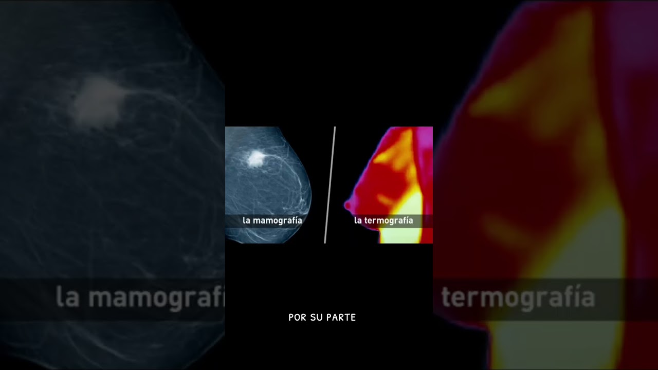 Mamografia VS Termografia