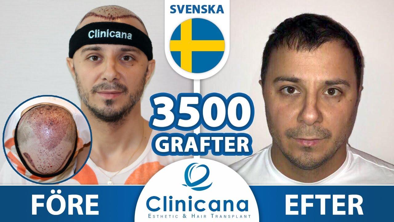 Hårtransplantation Turkiet | håravfall behandling | Clinicana Istanbul