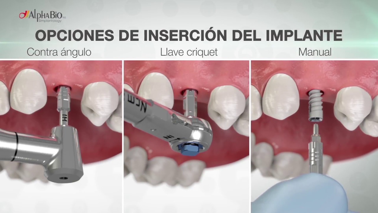 Implantes Dentales AlphaBio - Nuevo Packaging
