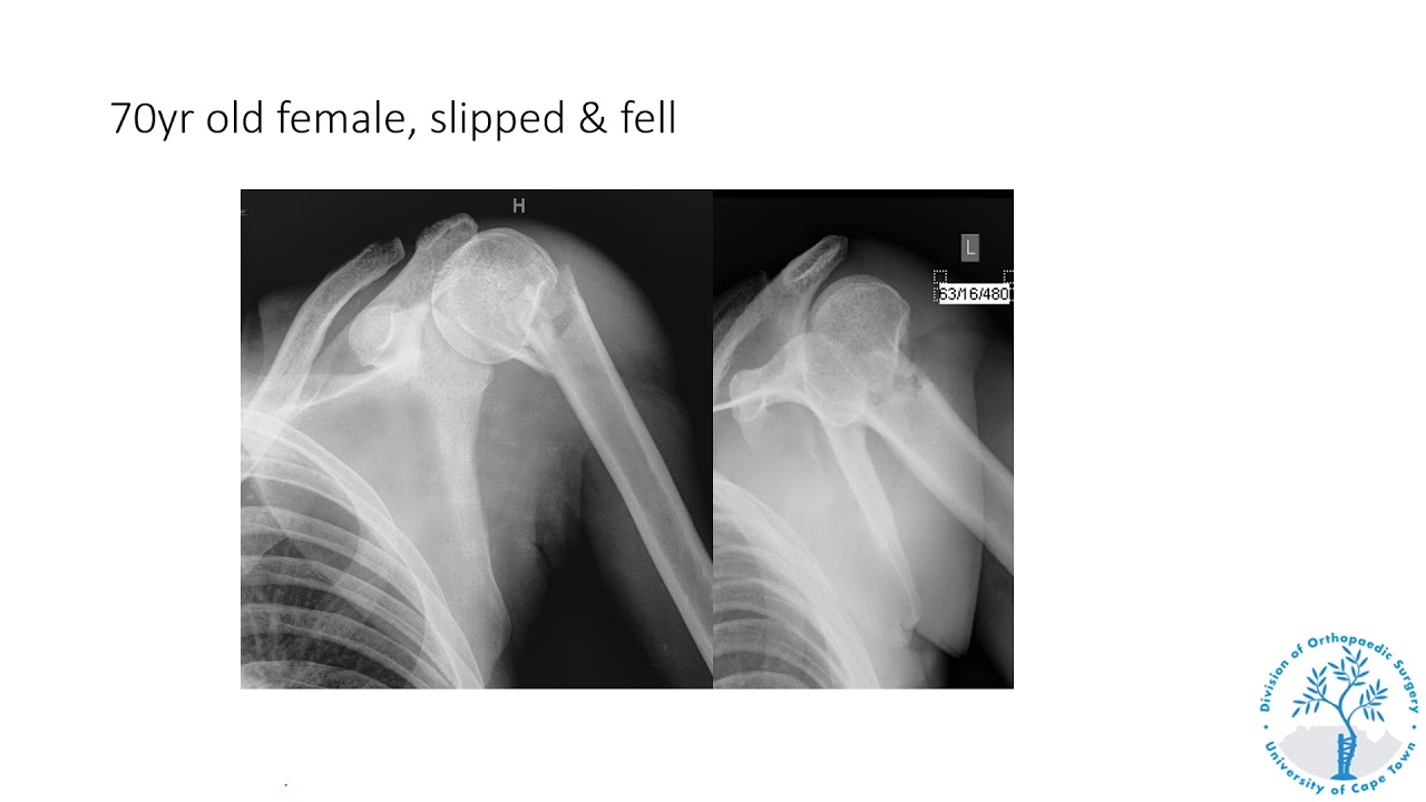Maritz Laubscher- Common upper limb fractures and dislocations