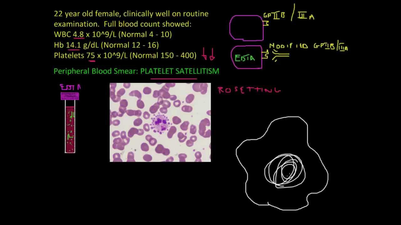 Platelet satellitism - Full Blood Count Masterclass series