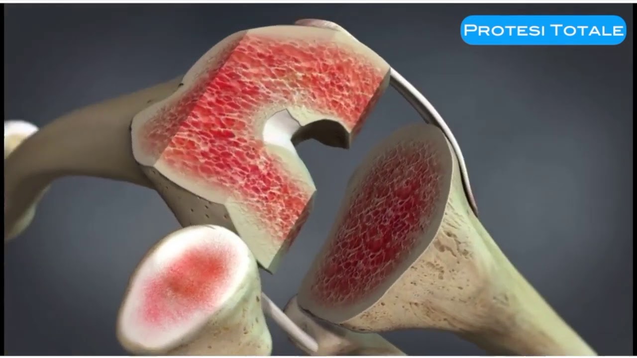 🇮🇹 LUCAGARRO.COM 🇮🇹 La protesi totale di ginocchio riassunta in un video digitale di 2 minuti