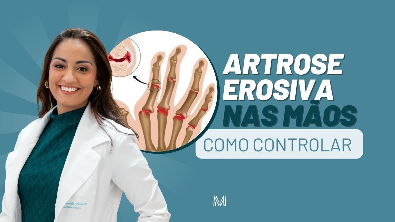 #Artrose Erosiva Nas Mãos: O Que É E Como Controlar A Deformidade