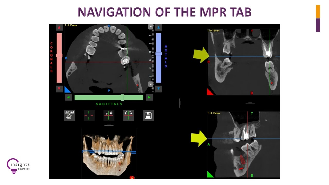 Insights Diagnostic - iRYS Software Tutorial - Navigation of the MPR Tab