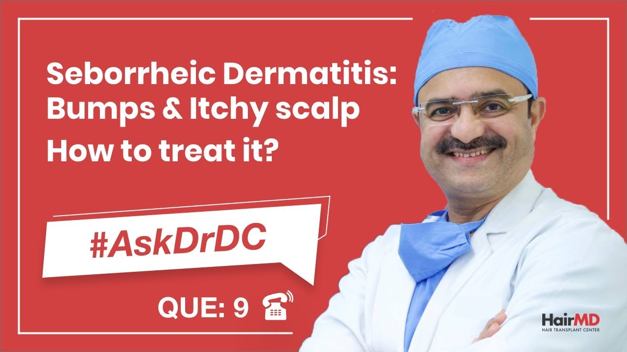 How To Treat Seborrheic Dermatitis (कैसे seborrheic का इलाज करे) | #AskDrDc Ep 9 | (In HINDI)