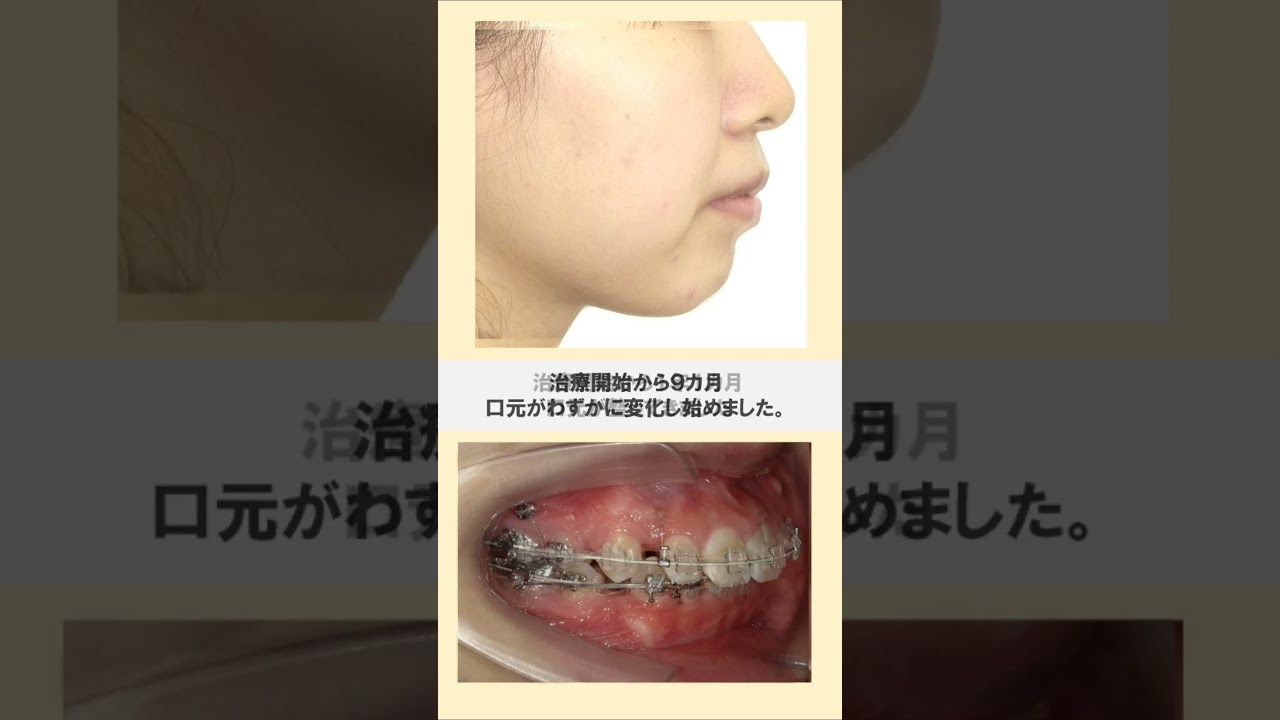 口ゴボの歯列矯正 |#歯科矯正 #braces＃出っ歯