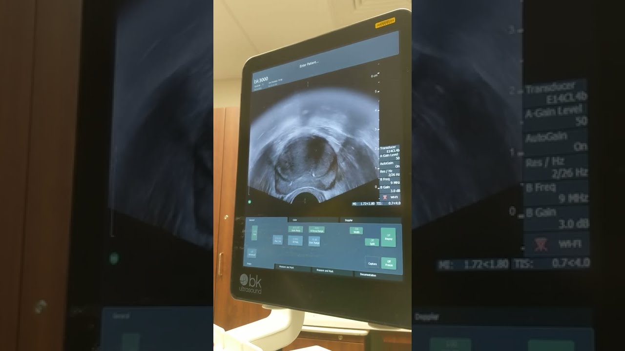 Depositing Fiducial Markers into Prostate, 20220920