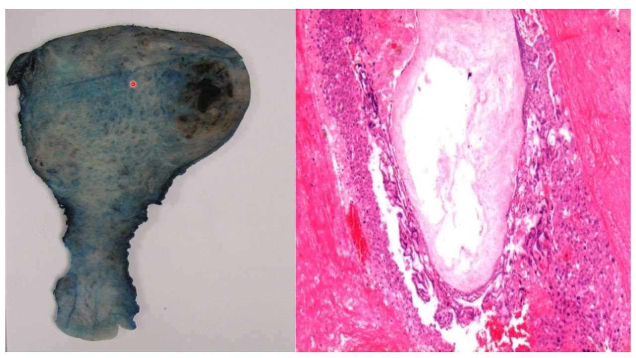 Pathology OF GTN: Overview