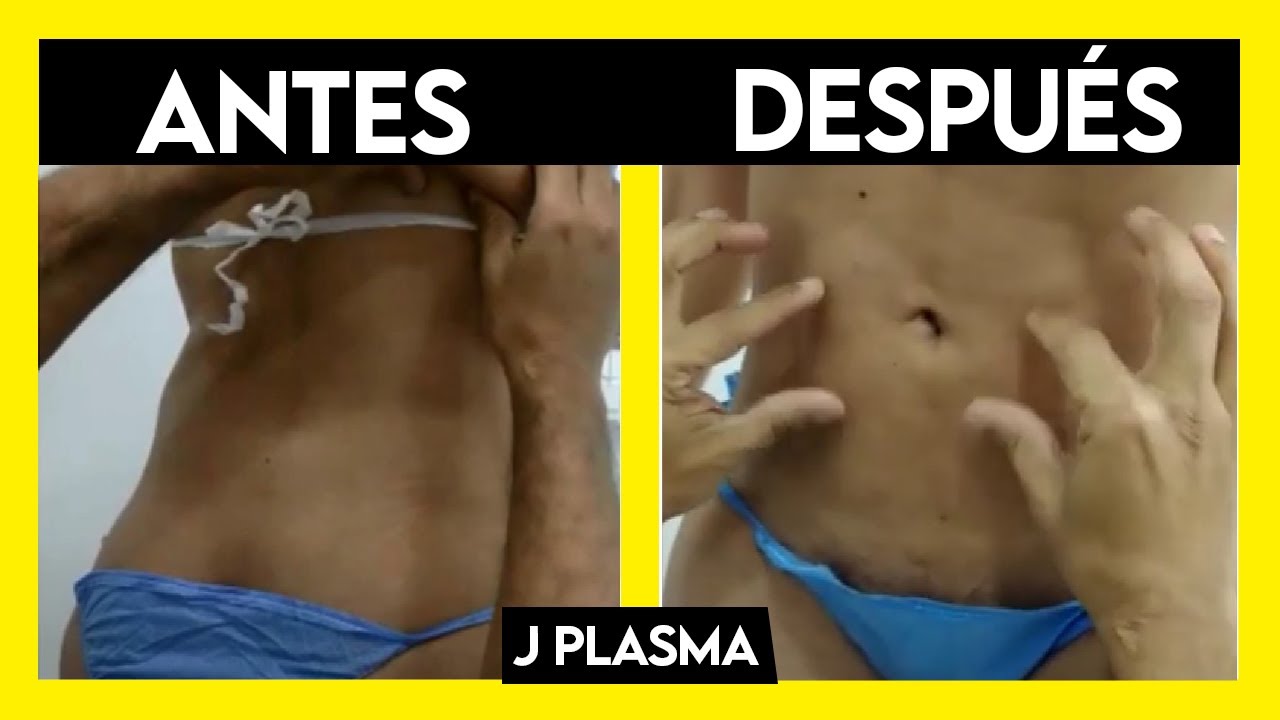 🔥 RETRACCIÓN DE PIEL EN ABDOMEN 🔥 Lipoescultura 360º + J-Plasma (Antes y Después) ► Dr John Garcia