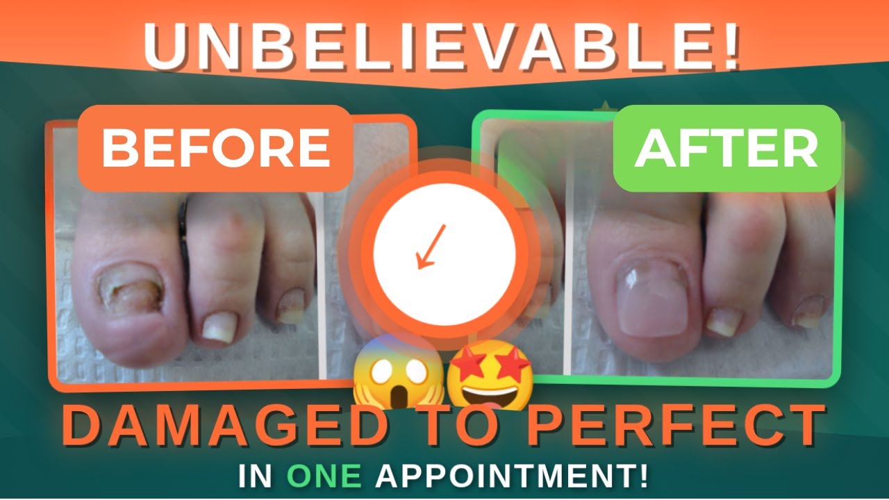 TRANSFORM Your Damaged Nails in ONE Appointment! 🦶