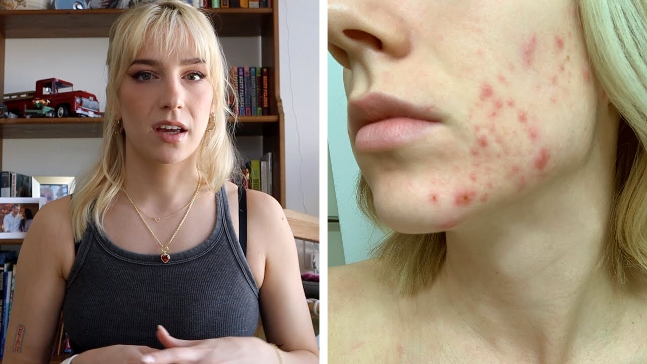 I used to hate my skin to the point of tears