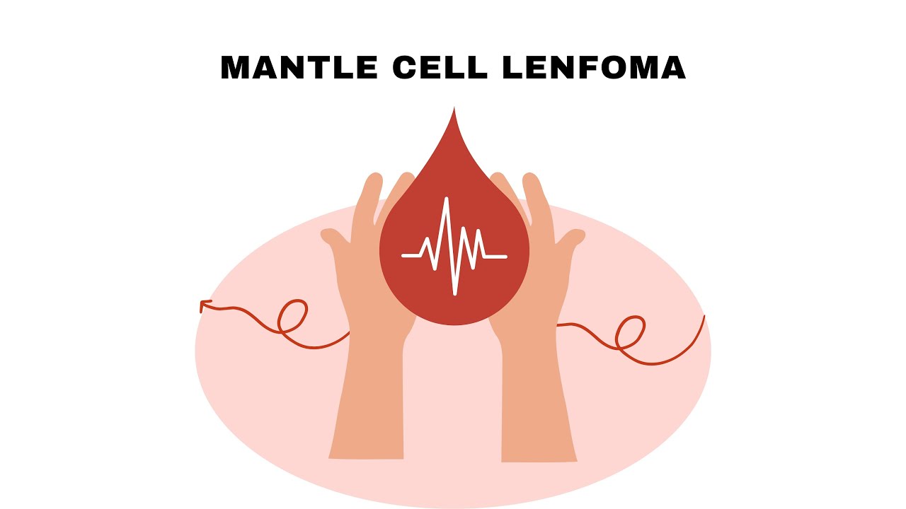 Mantle Cell Lenfoma