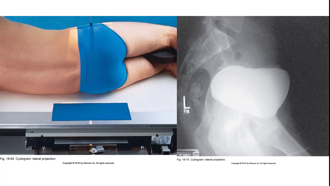 Cystography and Urography